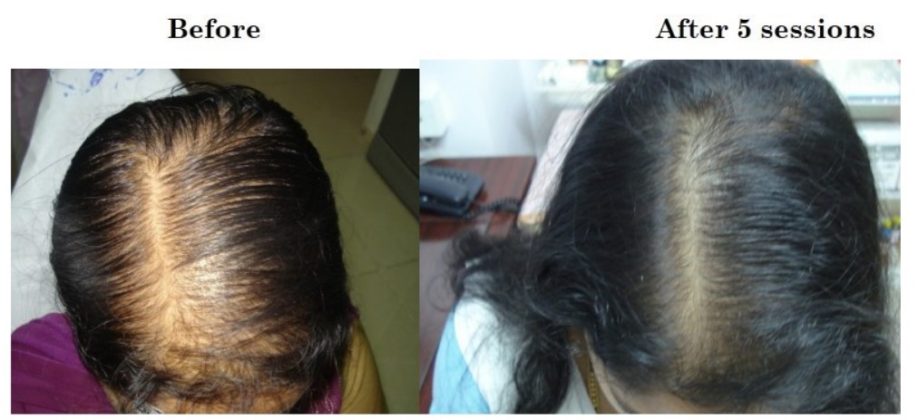 Prp Hair Loss Treatment In Bangalore The Venkat Center