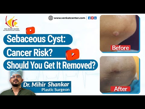 Sebaceous Cyst Removal in Bangalore, India | Venkat Center Bangalore