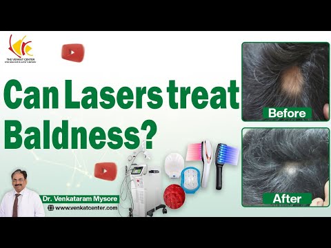 Laser Treatment for Hair Loss: Does It Work and Is It Right For You? Venkat Center Bangalore