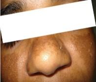 Mild Case of Melasma