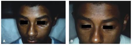 targeted phototherapy