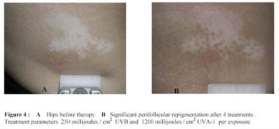 Targeted Phototherapy 13