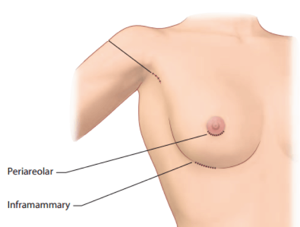 Best breast augmentation surgeon bangalore india