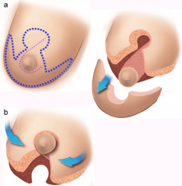 Complete Guide to Breast Reduction Surgery in India