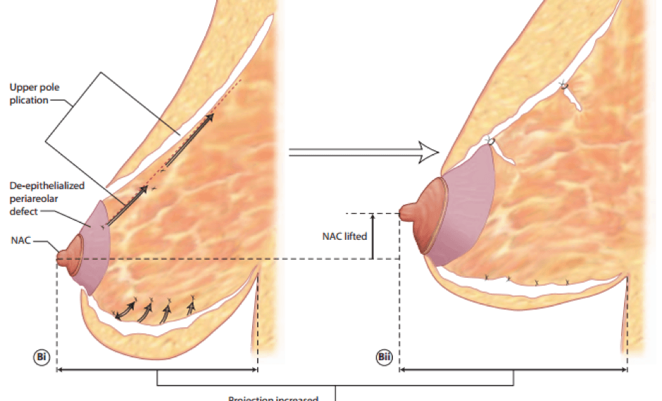 Periareolar Breast Reduction