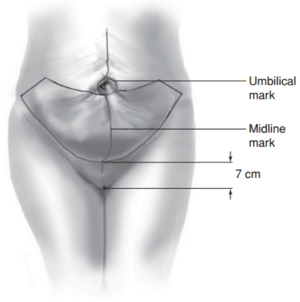 Patient M - 4 weeks Post-Operative Tummy Tuck and Sub-muscular