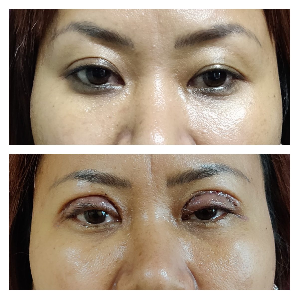 double eyelid surgery blog