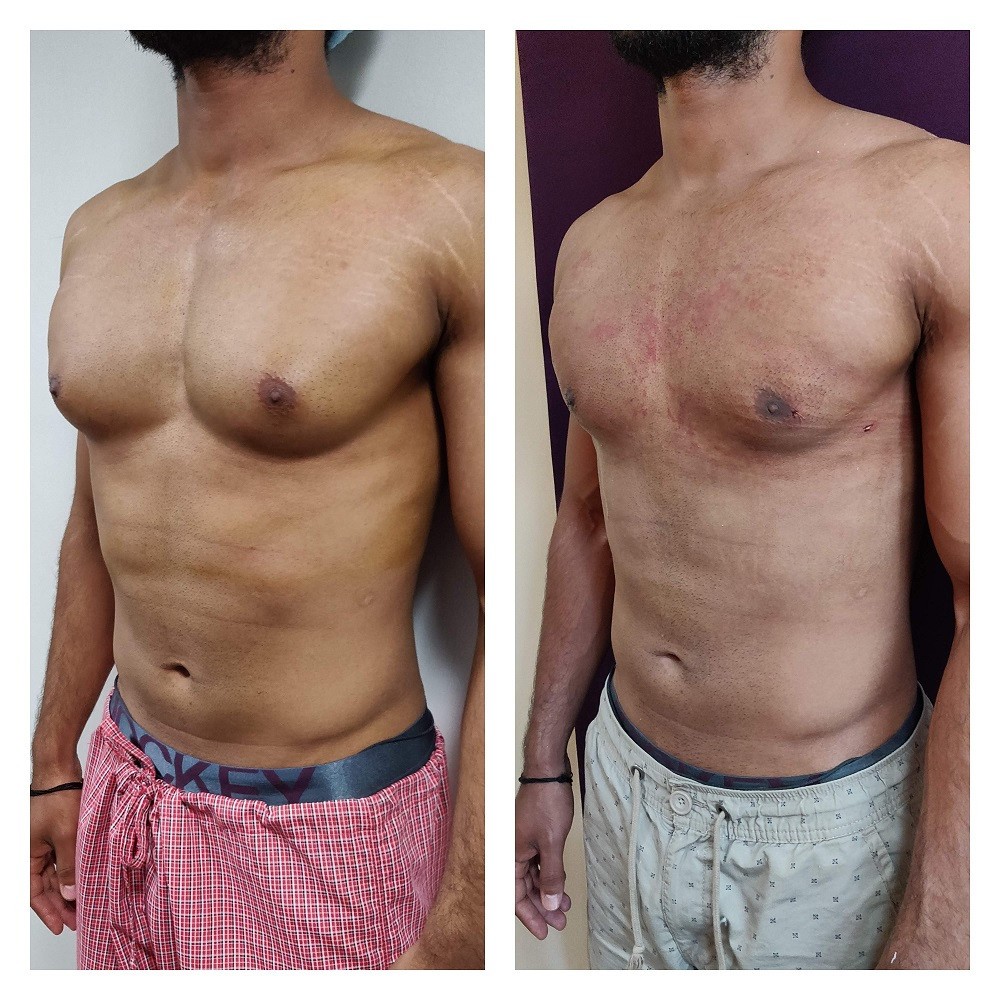 Gynaecomastia Surgery Cost In Bangalore India Best Gynecomastia 