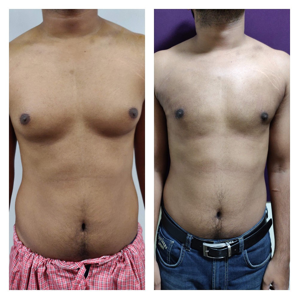 Gynaecomastia Surgery Cost In Bangalore India Best Gynecomastia 