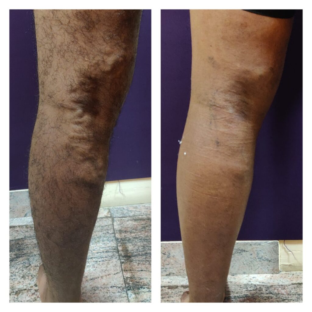 How Compression Stockings Treat Varicose Veins - St. johns Vein Center