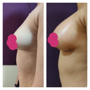 Tuberous Breast Correction - Chester