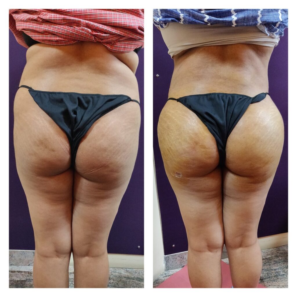 Best Butt Augmentation In Bangalore, India