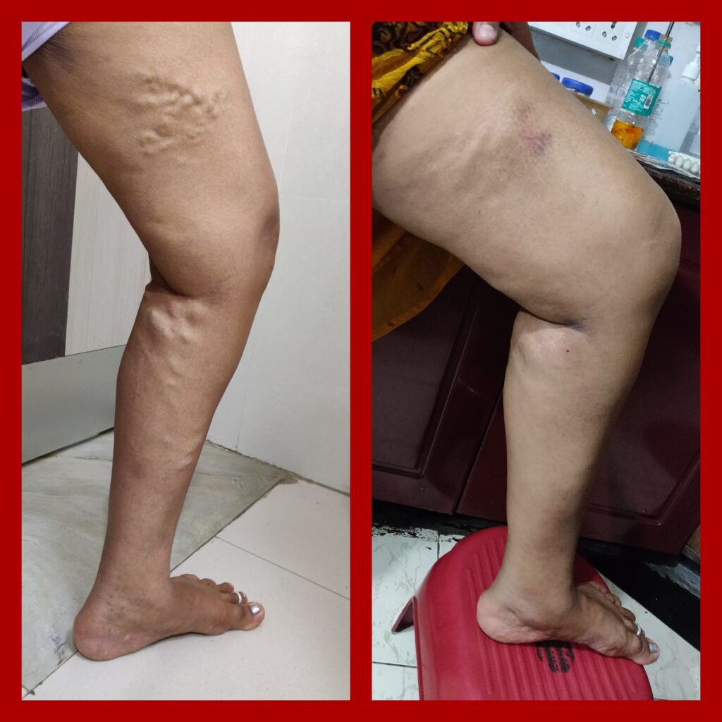 How Varicose Veins Are Treated