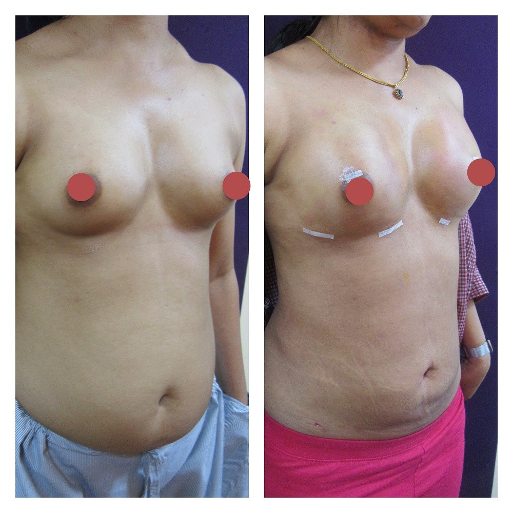 Why Fat Transfer Breast Augmentation is Gaining Popularity