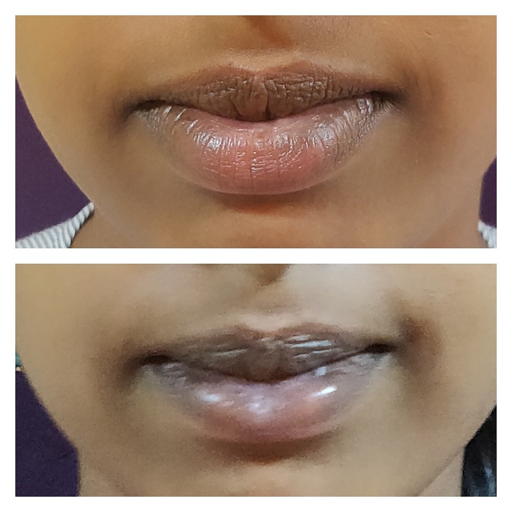 Lip Reduction Surgery Cost In Bangalore The Venkat Center