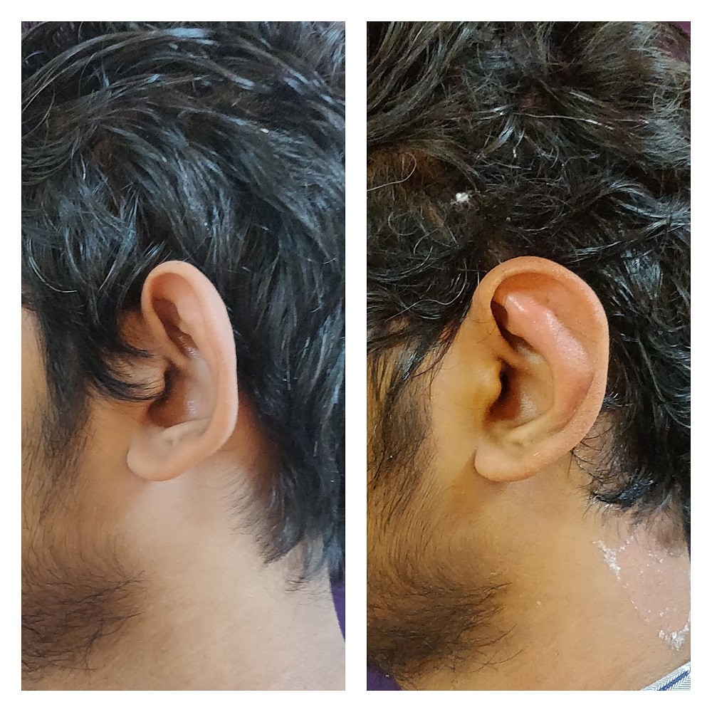 How to Reduce Large Ears and Earlobes - Visage Cosmetic Plastic Surgery