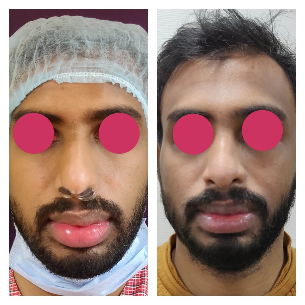 Lip Reduction Surgery Cost In Bangalore The Venkat Center