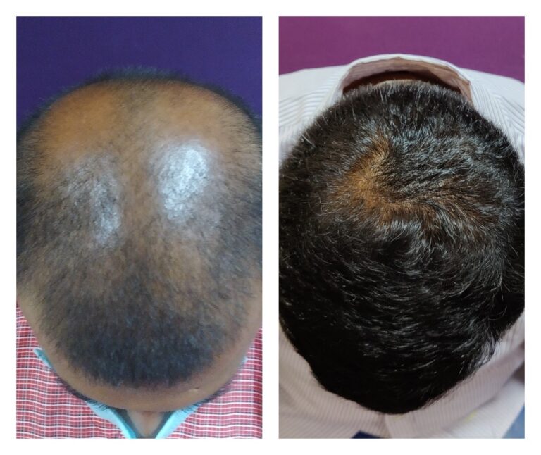 Crown Hair Transplant | Vertex Hair Transplant In Bangalore | Venkat Center