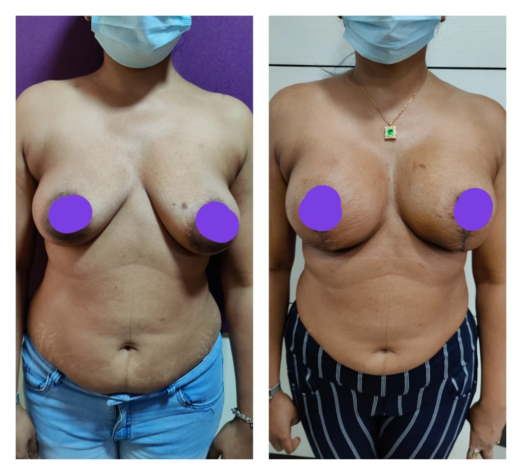 Breast Size Increase/Implants/silicone at best price in Indore