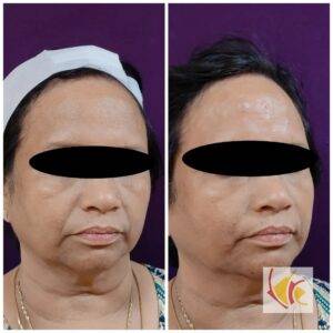 Dermal Filler Treatment 3