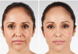 Anti-Ageing and Skin Rejuvenation