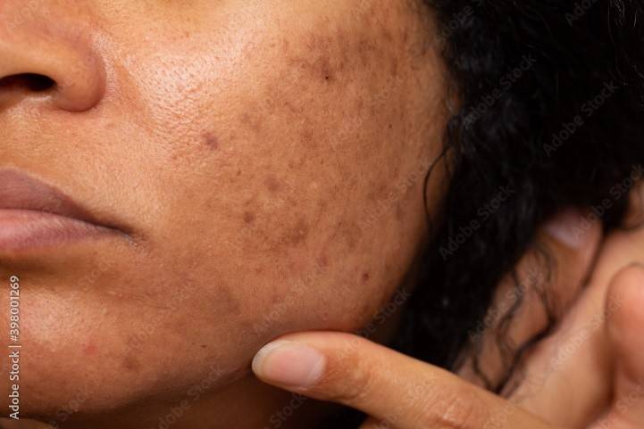 Dark Spots on the Face