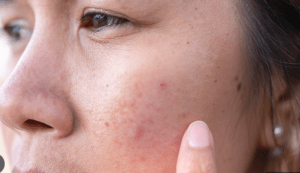 Acne Management during the Summer