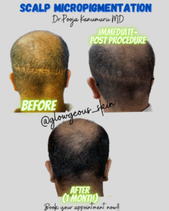 Scalp Micropigmentation