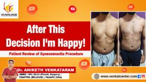 Gynecomastia