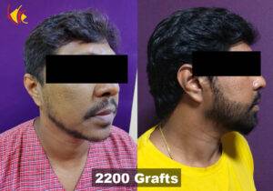 Beard & Moustache Hair Transplantation in Bangalore, India 2