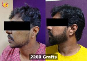 Beard & Moustache Hair Transplantation in Bangalore, India 6