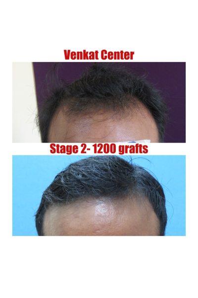 1200 grafts Hair Transplant results at Venkat Center