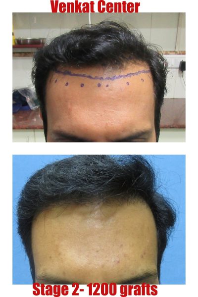 1200 grafts Hair Transplant results at Venkat Center