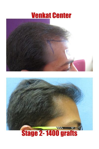 1400 grafts Hair Transplant results at Venkat Center