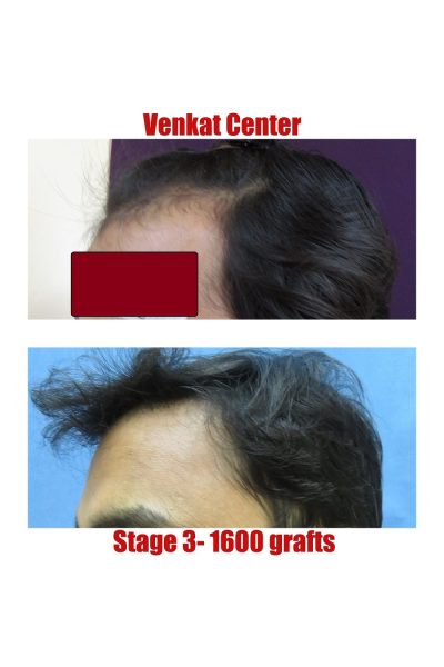 1600 grafts Hair Transplant results at Venkat Center