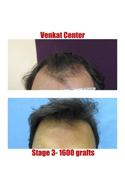 1600 grafts Hair Transplant results at Venkat Center