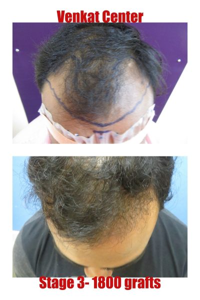 1800 grafts Hair Transplant results at Venkat Center