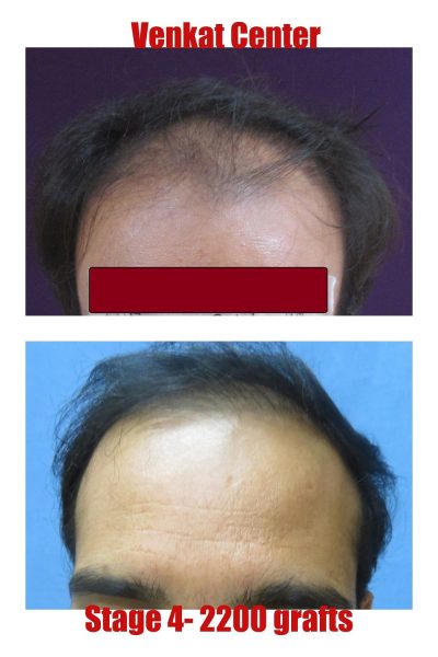 2200 grafts Hair Transplant results at Venkat Center