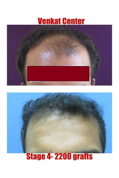 2400 grafts Hair Transplant results at Venkat Center