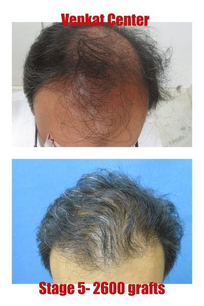 2400 grafts Hair Transplant results at Venkat Center