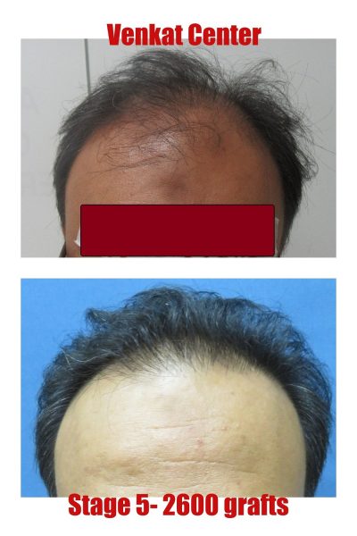 2600 grafts Hair Transplant results at Venkat Center