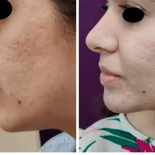 Acne Scars Treatment 1