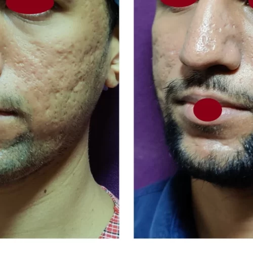 Acne Scars Treatment 2