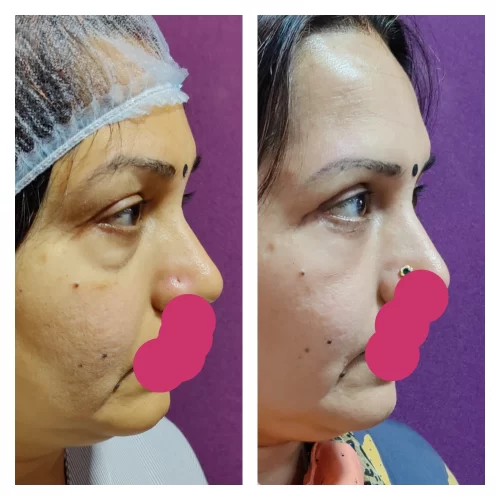 Ageing Eyelid Surgery Blepharoplasty Cost 7