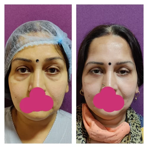 Ageing Eyelid Surgery Blepharoplasty Cost 5