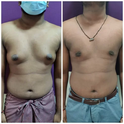 Gynecomastia Surgery 5