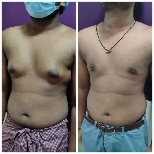 Gynecomastia Surgery 4