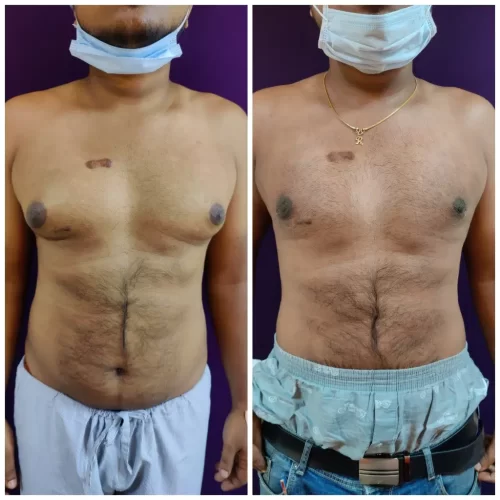 Gynecomastia Surgery 3