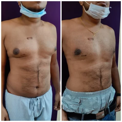 Gynecomastia Surgery 2