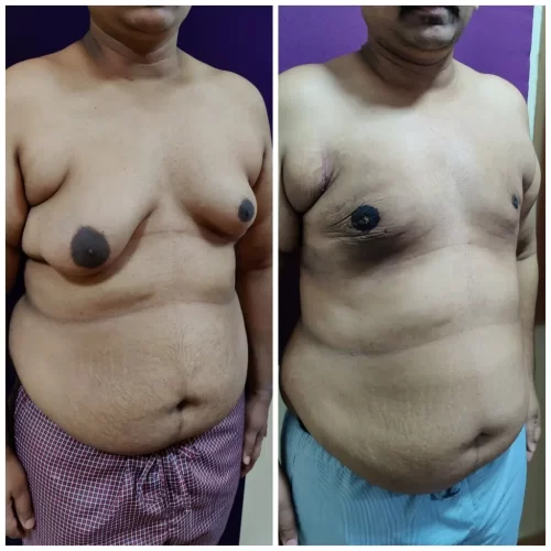 Gynecomastia Surgery 6